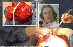 tumor Tumor 23kg Dikeluarkan Dari Perut Wanita Ini